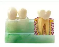 Disassembling Teeth Model- 4 parts